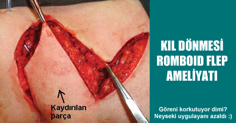 Kıl Dönmesi Romboid Flep