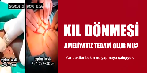Kıl Dönmesi Tedavi