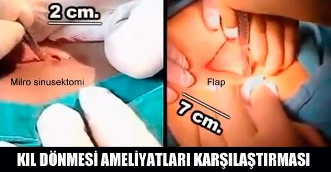 Kıl Dönmesi Video