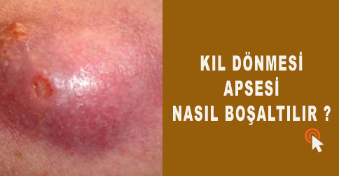 kil-donmesi-apsesi-nasil-bo